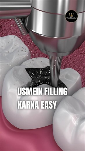 Dentist Explains: How To Fix A Cavity !? #cavity #dentalcare #viral #shorts