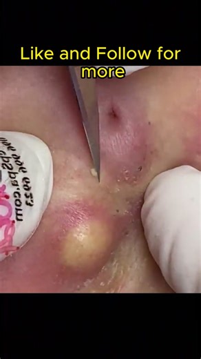 #pimple #pimplepop #pimpleremover #pimples #pimplepopperaddict #fyp #foryourpage #foryoupage