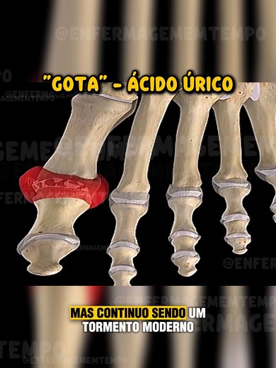 Entenda a Gota e o Ácido Úrico: Dicas de Saúde