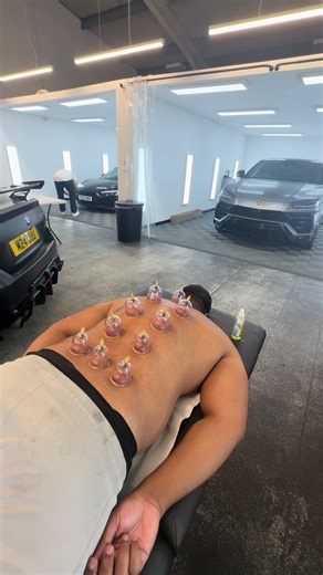 Discover the Health Benefits of Cupping Therapy