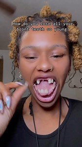 66K views · 41K reactions | How do you lose all your front teeth so young? #dentaldesignsmile #funny #comedyreels #porcelainveneers #dentalimplants #dentalart #cosmeticdentistry #smilemakeover | Dental Design Smile | Facebook