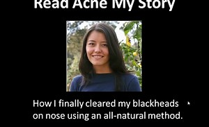 Blackheads On Nose - Blackhead Removal
