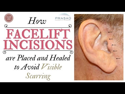 How Visible Facelift Incision Scars are Avoided, Treated, and Healed