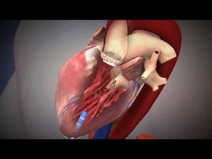 Percutaneous Valve Repair Procedure