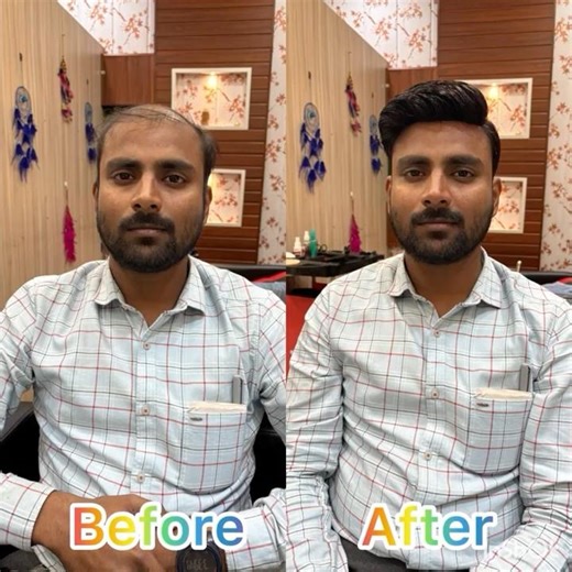 Gum System Hair Patch call 7002291828 | #best #hair #patch #wigs #hairstyle #assam #guwahati #near