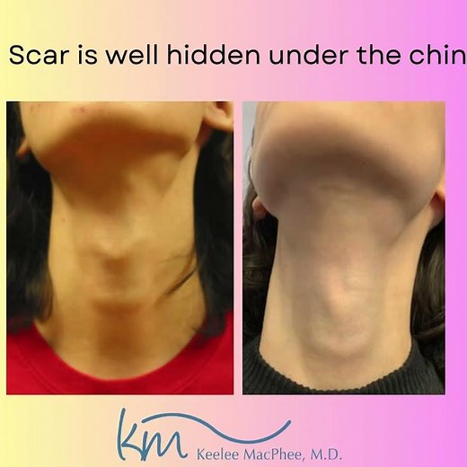 Tracheal Shave Surgery to reduce Adam's Apple prominence #youbeyou