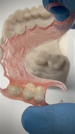 FiberFlex partial that was just completed in my lab for Dr. Morgan Johnson in Massachusetts