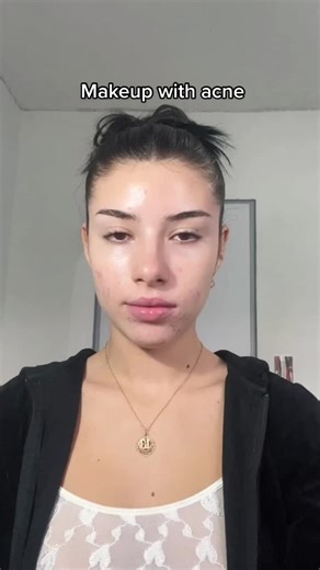 Embrace Your Natural Beauty with Fernanda's Acne Makeup Tutorial