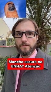 Uma mancha escura na unha pode, em alguns casos, ser um sinal de melanoma de unha, um tipo raro de câncer que afeta as unhas. No entanto, nem todas as manchas escuras nas unhas são causadas por melanoma, podendo ser também resultado de outras condições, como hematomas ou infecções. Melanoma de Unha: Sintomas: O principal sintoma do melanoma de unha é a presença de uma mancha escura na unha, que pode ser marrom ou preta, e que tende a crescer ao longo do tempo. A mancha pode aparecer como uma lin