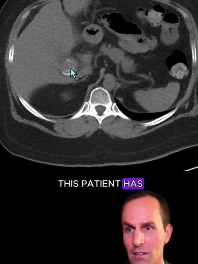 Understanding Cholecystitis on CT Imaging