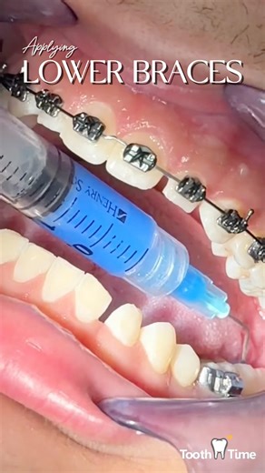 ADDING LOWER BRACES!🦷🪥😁 Tooth Time Family Dentistry