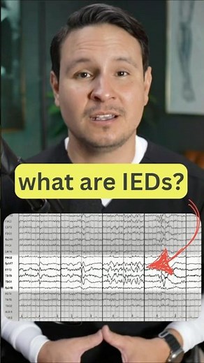 Interictal Epileptiform Discharges on EEG #eeg #neuroscience #epilepsy #neurology #seizures