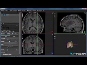 Interactive Segmentation of Medical Data using ImFusion Suite