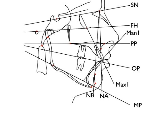 Kuwait University Cephalometric Tracing Demo - Human Voice