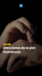 Si de pronto te aparecen granitos en las manos y los dedos aparentemente de la nada y que te pican, puede que estés sufriendo de dishidrosis. La dishidrosis es una afección en la piel que suele aparecer en personas estresadas, con renitis alérgica, dermatitis atópica o piel sensible. | Radio Bio Bio