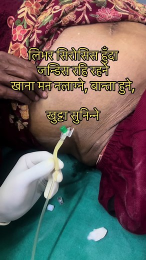 Understanding Causes of Liver Cirrhosis