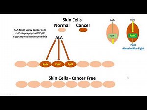 Photodynamic Therapy