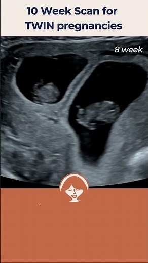10 Week Scan for Twins.