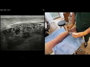 Procédure d'allongement de la lame des gastrocnémiens selon la technique de Strayer