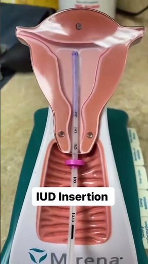 IUD insertion simplified