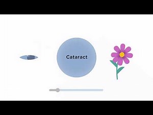 Cataract Surgery Fixed vs Adjustable Lenses | RX Sight | Light Adjustable Lens