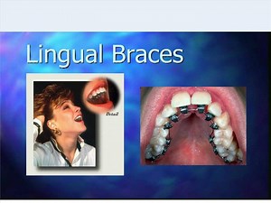 lingual braces - SlideServe