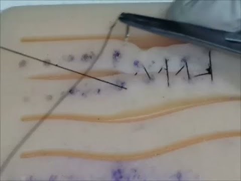 (20) Lembert and Halsted Sutures for lumen repair