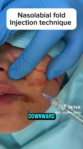 Nasolabial Fold Filler Injection Techniques Explained