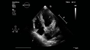 Apical four chamber view on Transthoracic Echocardiography show left atrium myxoma