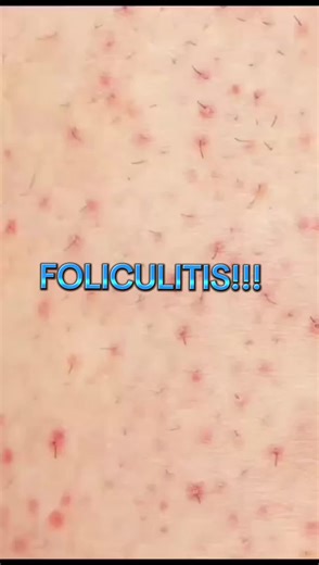 Foliculitis: Causas, Tratamientos y Prevención
