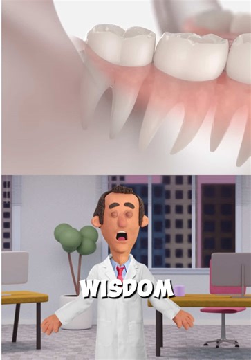 What happens if you don’t get your wisdom teeth removed? #health #fitness #wisdomteeth