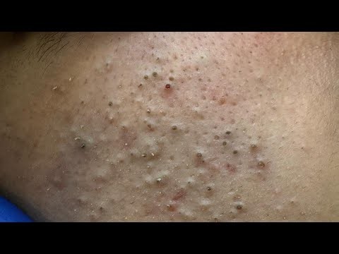Deep Zit Extraction & Blackhead Removal | Skincare Solutions & Beauty Routine