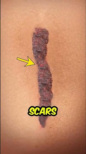 Why Your Skin Leaves a Scar After Healing