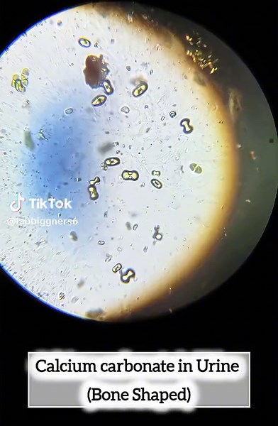 The formation of calcium carbonate crystals can be caused by alkalinizes (increases the pH of) urine, such as a vegetarian diet, chronic diarrhea. #fyp #fyp #viral #labbiggners6