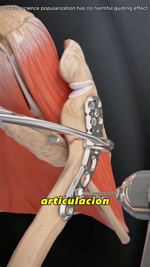 "How Clavicle Fracture Repair Surgery Fixes a Broken Collarbone (3D Animation)#claviclefracture "