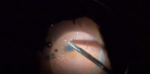 Long-Standing Retinal Detachment and Subretinal Trocar - Eyetube