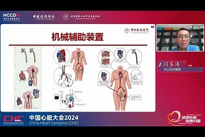 机械辅助：如何评价ECLS-SHOCK研究？ 闫圣涛