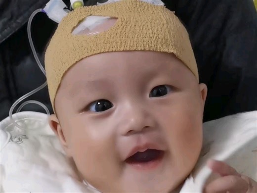 头上扎着针还嬉皮笑脸