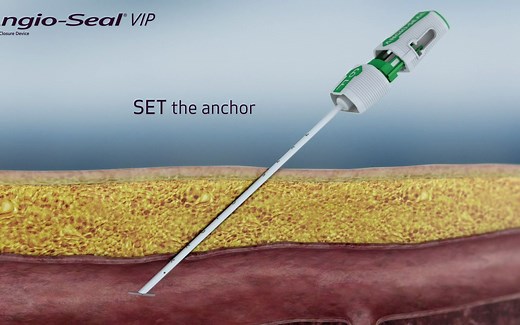 血管闭合装置系列：Angio-Seal工作原理动画演示