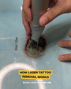 144K views · 169 reactions | This laser tattoo removal process is amazing  | Comedy JOE | Facebook