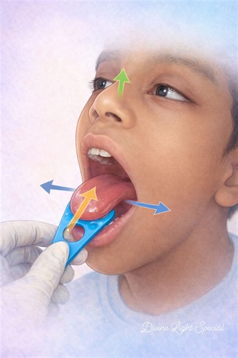 One Tool, Many Tongue Movements 👅 | Speech Therapy Awareness This short video demonstrates a multi-dimensional tongue exercise used in speech therapy to improve tongue awareness, strength, and control. With gentle guidance and the right tool, children can build the foundation needed for clearer speech and better oral motor skills. Especially helpful for children with speech delay and special needs. 📍 Divine Light Special – Supporting communication, one step at a time. #SpeechTherapy #OralMotor