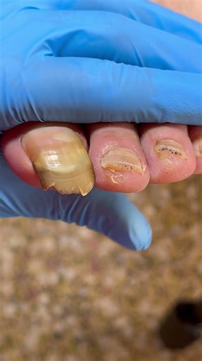 Her Toenails Haven't Been Trimmed In Two Months~ #satisfying #pedicure