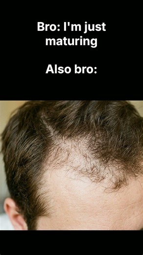 10,000+ men track their hairline with BaldingAI, how to do it right