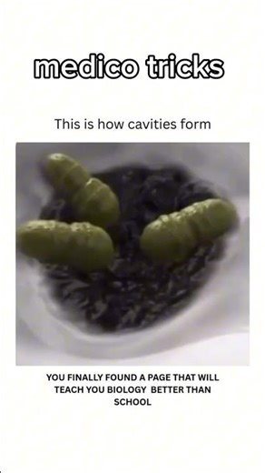 How teeth cavity form #mbbs #teethcare #teethcavity