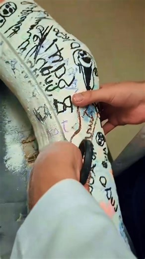 The Doctor Strange Help Patient Removal Cast Broken Arm In Hospital So Pain 😱 #cast #removal #cutting #help #patients #doctorstrange #fyp #emotional #hospital #medical #brokenarm #brokenb#396 | Harish Shorts Reels