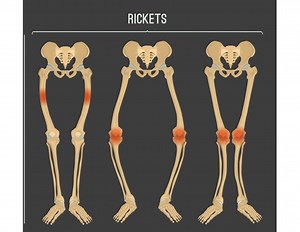 Rickets Symptoms