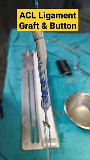 ACL Ligament Graft with Endobutton Implant ✓ #acltear #aclsurgeryrecovery #aclrehab #ligamentinjury