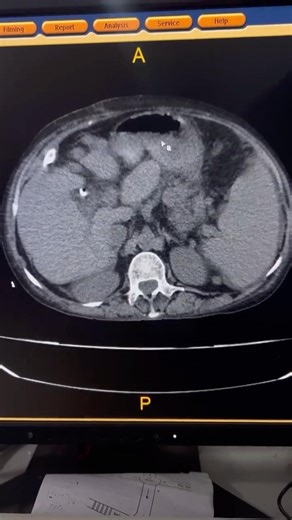 Liver Abscess vs Fistula CT | Contrast Study Fistula Diagnosis #shorts