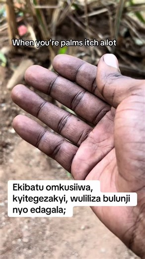 What It Means When Your Palms Itch