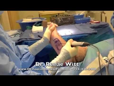 The Topaz Procedure for Treatment of Plantar Fasciitis: Dr Renae Witt D.P.M.